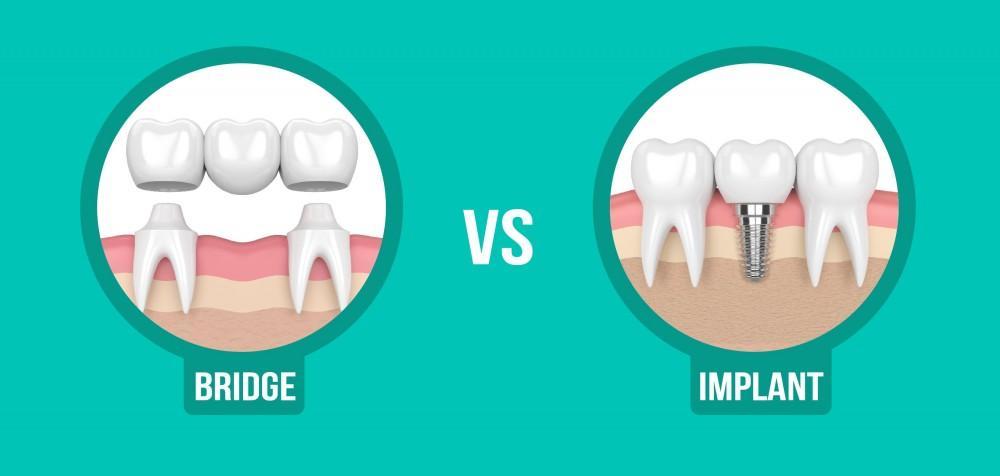 Dental Implants VS Bridges